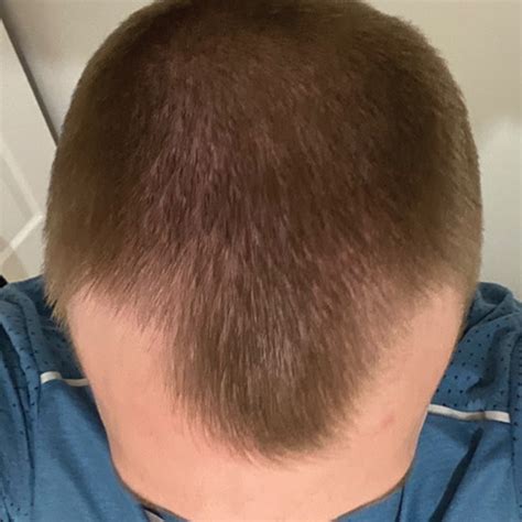 Buy Topical Finasteride & Minoxidil for Hairloss | Sons UK