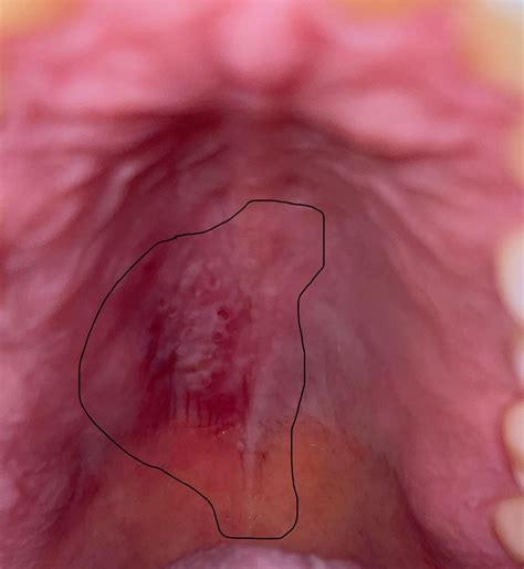 Mouth sores : r/Autoimmune