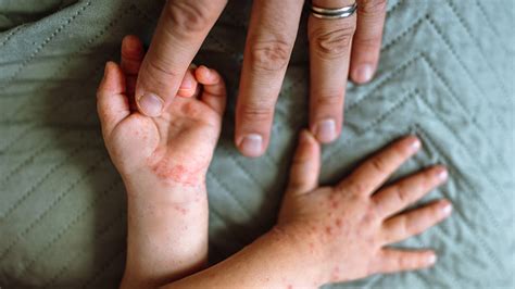 parents guide  hand foot  mouth disease northwestern medicine