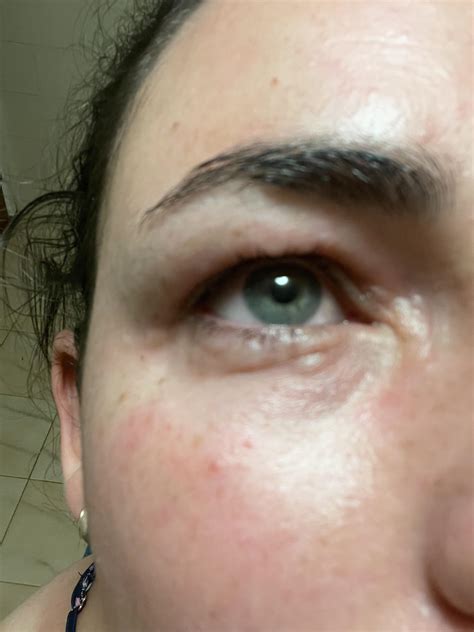 Cat scratched me on my face but my eye swelled up. Not allergic to cats