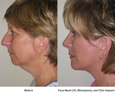 Mini Facelift in Los Altos CA: Trustworthy Facial Rejuvenation