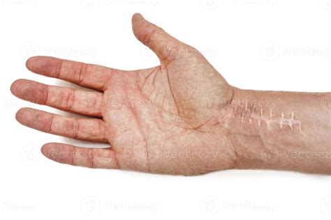 Scar with stitches on the wrist after surgery. Fracture of the bones of