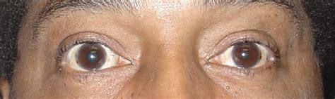 Double Pupil Eye