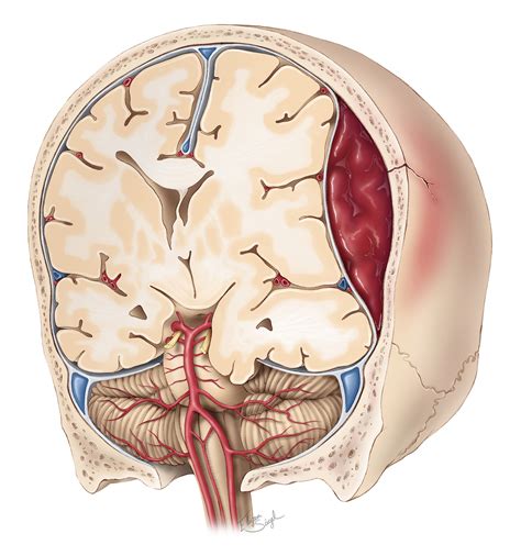 Epidural Hematoma | The Neurosurgical Atlas