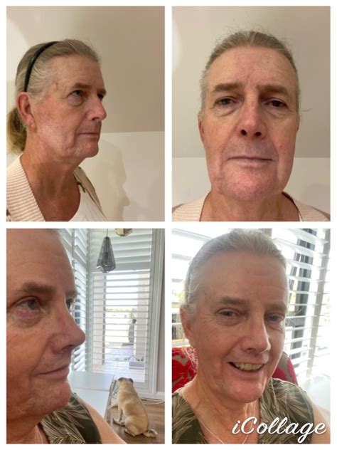 1365 best Swelling images on Pholder | Plastic Surgery, Piercing and