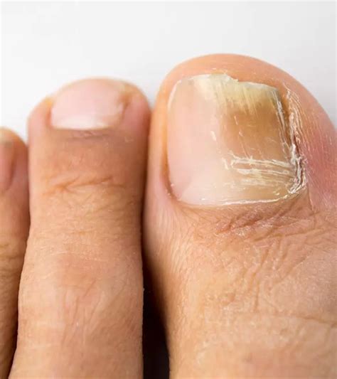 Tratamiento para hongos en las uñas – Artofit