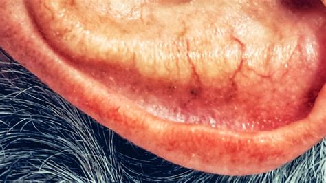 skin cancer   ear signs  symptoms encyclopedia mdpi