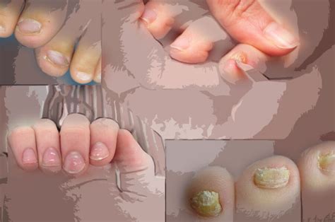 Слабые ногти: почему ломаются пластины