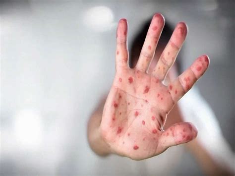 Measles: What Are Measles?