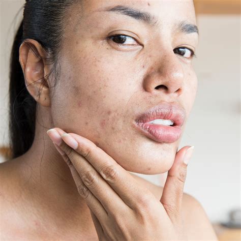 Herpes Symptoms, Causes & Treatments | SELF