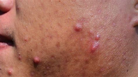 Back Acne (‘Bacne’) 101: Types, Prevention, and Treatment | Everyday Health