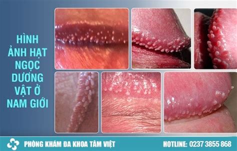 tim hieu cach tri hat ngoc sinh duc hieu qua