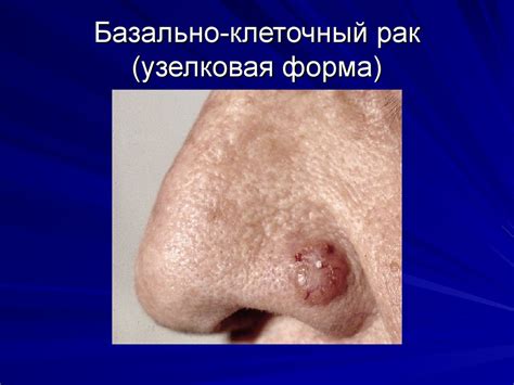 Рак кожи и меланома - презентация онлайн