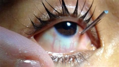 eye trauma eyes alive