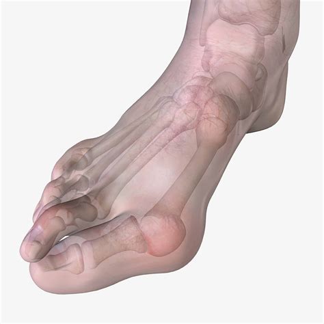 Are Bunions Hereditary? Understanding Your Risk and Prevention