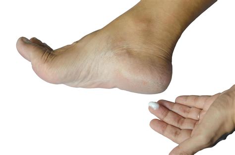 Cracked heels white background 1901085 Stock Photo at Vecteezy