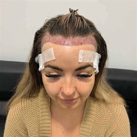 The thinning hair on men cause that experts just discovered 28