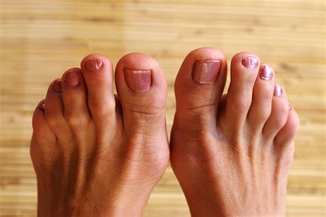 Yellow Spots On Toenail at Randy Eubanks blog
