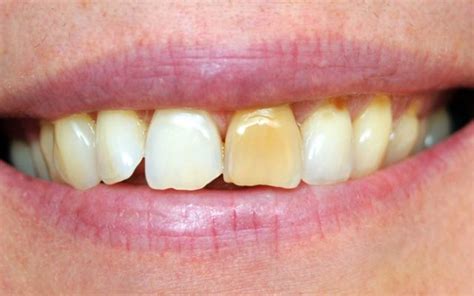 brown stains  teeth   treatment  bassendean