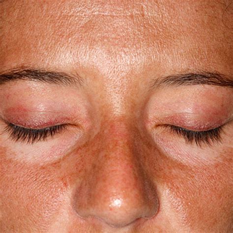 Dermatomyositis Face
