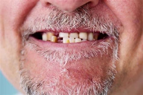 130 Tooth Absence Stock Photos - Free & Royalty-Free Stock Photos from ...