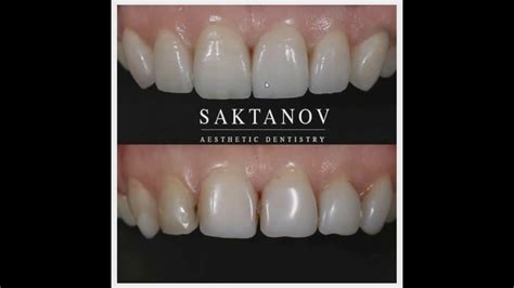 Виниры цена Алматы | Керамические виниры вместо композитных | Пример ...