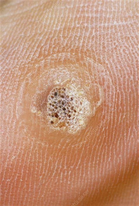 verruca stock image  science photo library