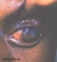 Staphyloma. EyeRounds.org: Online Ophthalmic Atlas