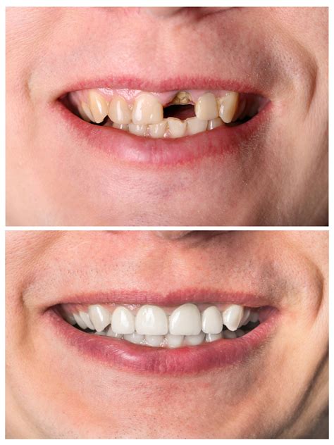 Restorative Implant Dentistry at Savannah Derrington blog