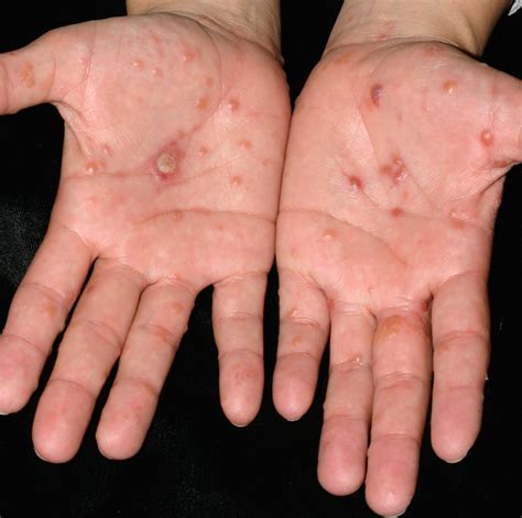List 92+ Pictures Pictures Of Dyshidrotic Eczema On Hands Updated