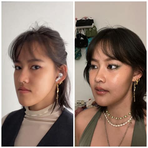 1 month post op with pics (double jaw surgery for underbite), no