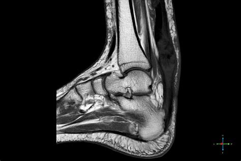 Achilles Tendon Xanthoma-MRI - Sumer's Radiology Blog