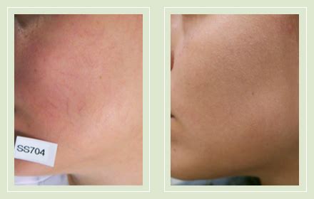 Facial Veins – The Vein Treatment Center