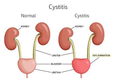 cystitis