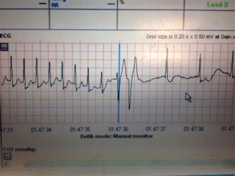 Ladies and gents. Proof that vagal maneuvers do work !!! : ems