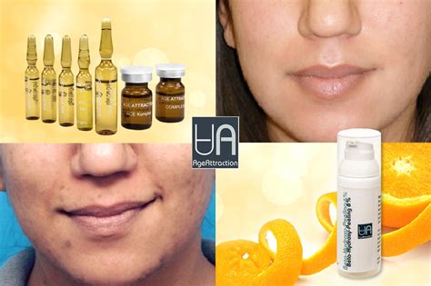 Beta – Hydroxy – Madmazel Kozmetika & Webshop