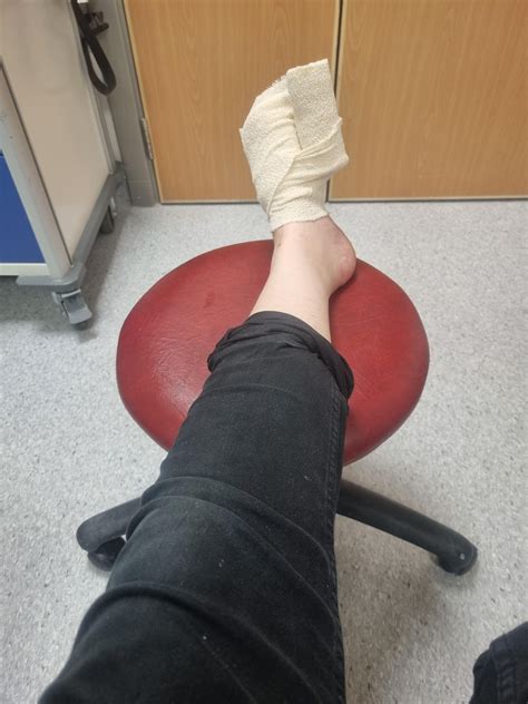 My foot after boiling pot of pasta water fell off the stove. All healed