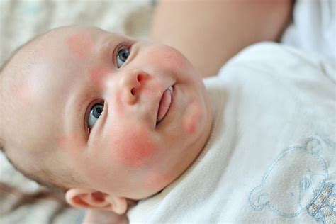 baby egg allergy rash pictures - Terrell Stjohn