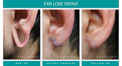 ear lobe eczema treatment  jenenge blog