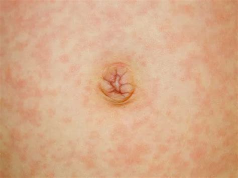 roseola  measles whats  difference