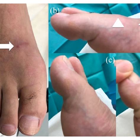 removal   corpus liberum  scientific diagram