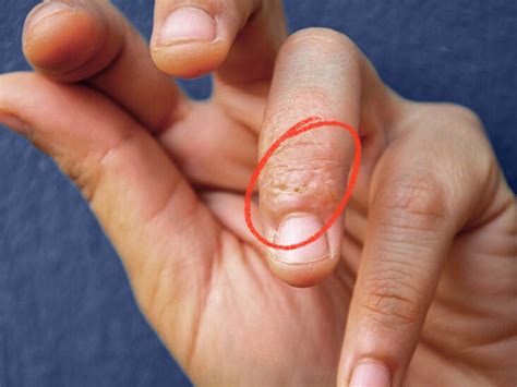 Dyshidrotic Eczema (Dyshidrosis): Symptoms, Causes,, 52% OFF