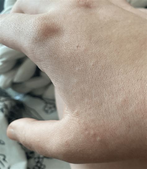 Woke up with tiny bumps all over both hands 2 days ago? (not itchy, no ...