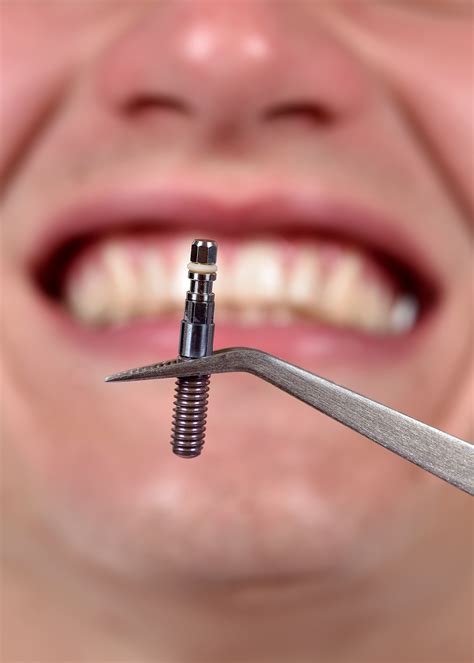 Dental Implant Failure: Smoking - Nashville, TN