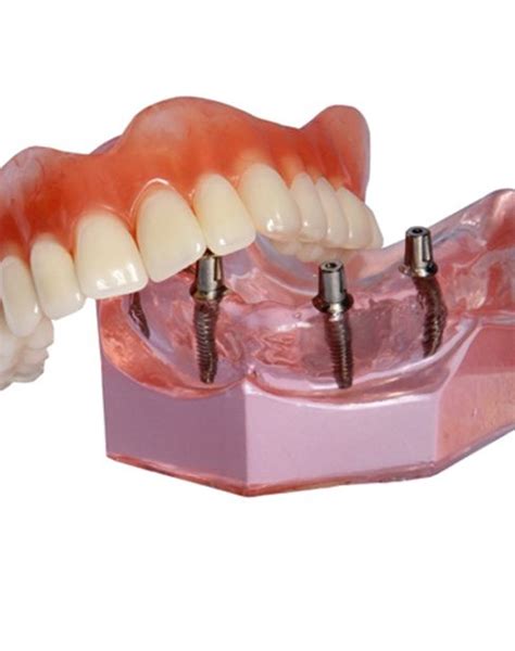 Implant Dentures