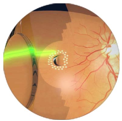 intravitreal injection intravitreal injections  eyeshots jelly