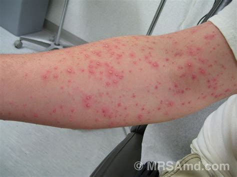 MRSA at emaze Presentation