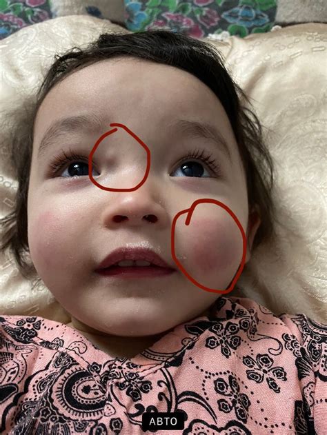 Уплотнение и красная щека — 10 ответов | форум Babyblog