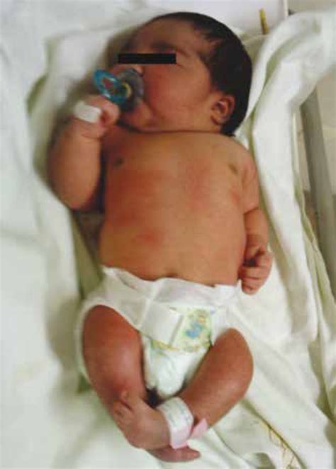 figure   caudal regression syndrome  case report semantic scholar