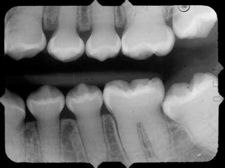 DENTINOGENESIS IMPERFECTA – Dentowesome